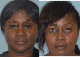 Case #8960 - Rhinoplasty - Female, African American patient who desired refinement to her nose. Her main concerns included her bulbous tip and the flare of the base of her nose. Primary rhinoplasty techniques included osteotomies, caudal septal extension graft for tip support, tip graft, and alar flare reductions.