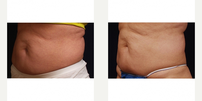 Woman treated with UltraShape Power - Woman treated with Ultrashape Power fat reduction