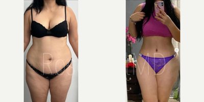 Woman treated with Tummy Tuck, Lipo 360 - Woman treated with Tummy Tuck, Lipo 360