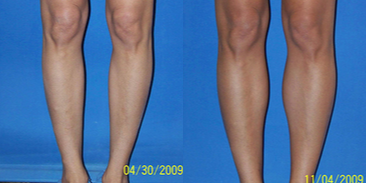 Calf Implant - 36 year old female from miami 6 months after medially placed calf implants
