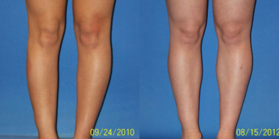 Calf Implant - 29 year old female 2 years after calf implants placed on the medial / inner aspect.