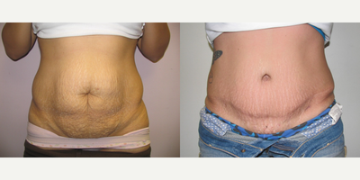 Woman treated with Mommy Makeover - Abdominoplasty (tummy tuck) with muscle plication (reconstruction) without liposuction, f/u at 6 months