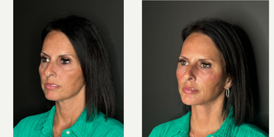 45-54 year old woman treated with PRF Treatment - This clients primary concern was her under eyes. Using PRF gel we injected under her eyes, to the temples and a small amount in her jawline and nasolabial folds.