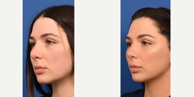 25-34 year old woman treated with Botox and HA fillers - With Botox, I performed a chemical brow lift, followed by Restylane filler to the cheeks, under-eyes, lips, and jaw-line (total of 2 syringes). This gave her a refreshed, yet natural improvement that improved her confidence and overall facial harmony.