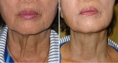 45-54 year old woman treated with Skintyte - What exactly is SkinTyte?SkinTyte is a pulsed light technology that heats deep within the skin while protecting and cooling the surface. The laser is able to accomplish this via selective thermolysis. Best of all, there is absolutely no down time.