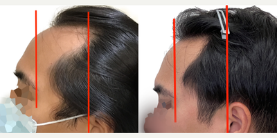 25-34 year old man treated with Rogaine - This is a 29-year-old male patient who came to us with a 4-year history of hair loss, with a significant recession of his frontal and temporal (side) hairlines. This resulted in the appearance of deep recessions that, even before age 30, were extending well behind his ears.Hed already started finasteride about a year before his surgery and noticed that his hair loss had stopped. He had no side effects from this medication.We did an 1800 graft FUE procedure to advance his frontal hairline only, which effectively brings it down along the sides to improve the deep recessions. He didnt want to bring the temporal (side) hairlines forward just in case he had future recession in that area behind the transplanted hair. His result (shown at 1-year post-op)! Even though we only advance the frontal hairline by about 1cm (as seen on the surgical markings), you can see from the photo markings that his hairline was brought significantly closer to his eyes, and the frontal-temporal points are now well ahead of his ears, instead of behind them. The overall result is very natural and very masculine looking, and is sure to continue to be well into the decades ahead. Immediately following his surgery he was also started on high-strength topical minoxidil to further enhance his surgical result, and this patient is continuing on that combination of finasteride and minoxidil to keep his hair looking great for decades to come.