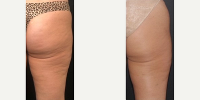 Woman treated with Cryoskin - Woman treated with Cryoskin
