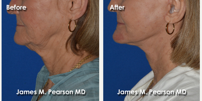65-74 year old woman treated with Facelift - 65-74 year old woman treated with Facelift
