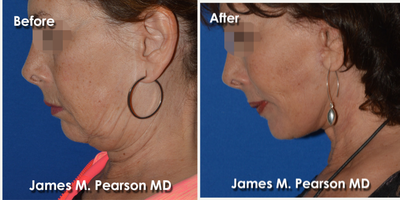 55-64 year old woman treated with Facelift - 55-64 year old woman treated with Facelift