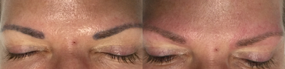 35-44 year old woman treated with Enlighten - Patient received enlighten laser tattoo removal for microblading correction. Significant clearance of microblading ink was noticed after one enlighten laser treatment.