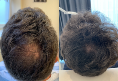 18-24 year old man treated with Mesotherapy - Young patient with androgenic hair loss. 5 months after scalp mesotherapy treatment.