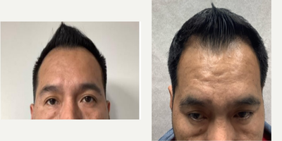 45-54 year old man treated with PRP for Hair Loss, Nutrafol - 3 month combination therapy prp + nutrafol, + minoxdil