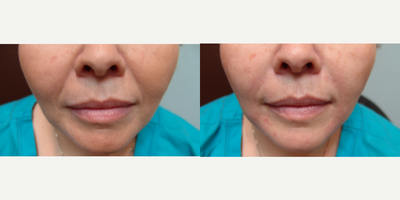 35-44 year old woman treated with Injectable Fillers - 42-year-old female immediately following an injectable filler treatment. 1cc of Juvederm Vollure XC was injected into the naso-labial fold (laugh lines) and marionette lines located at the corners of the lower lips. This was a thirty minute in-office procedure and topical anesthesia was used. 