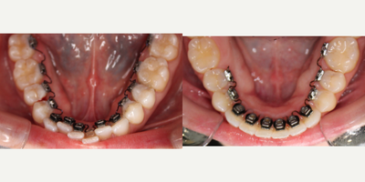 25-34 year old womanprogress with Lingual Braces - Patient's 6 month progress in Inbrace (lingual) braces on her lower arch.