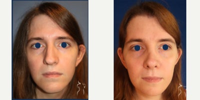 25-34 year old woman treated with Facial Feminization Surgery - FACIAL FEMINIZATION: TYPE 3 FOREHEAD REDUCTION, RHINOPLASTY (NOSE JOB), REDUCTION GENIOPLASTY AND JAW ANGLE REDUCTION