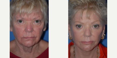 Facelift - Natural rejuvenation with facelift plus eyelid surgery and CO2 laser resurfacing