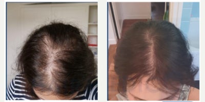 45-54 year old woman treated with Hair Transplant - This 4554-year-old female patient came to our clinic with progressive frontal thinning and reduced density that negatively impacted her appearance and confidence. After a detailed consultation and donor area evaluation, she was found to be a suitable candidate for a DHI (Direct Hair Implantation) hair transplant.The procedure was performed using the DHI technique, which allows grafts to be implanted directly without the need for prior incisions, offering greater precision and a natural look. A total of 2,700 grafts were harvested from the occipital donor area and carefully implanted into the frontal region, restoring density and creating a feminine, natural-looking hairline.To improve graft survival and promote healing, one session of PRP therapy was also performed during the operation.For post-hair transplant care, the patient was advised to follow a dedicated regimen, including Folliactiv shampoo and spray containing Saw Palmetto extract, to strengthen the transplanted hair, reduce shedding, and support long-term results.The procedure was carried out under local anesthesia with minimal discomfort, and the patient was able to return to normal daily activities within just a few days. At follow-up, she achieved excellent density and a natural hairline design that blended seamlessly with her facial features. The outcome provided a remarkable improvement in both her appearance and self-confidence.