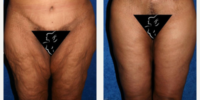 55-64 year old woman treated with Thigh Lift - This female patient in their late-50s was unhappy with the excess skin and fat of their thighs after losing 140 pounds. So, Dr. Katzen performed a thigh lift in Beverly Hills to tighten the patients thighs after their massive weight loss. The patient is extremely happy with their results! What do you think? Comments welcomed.
