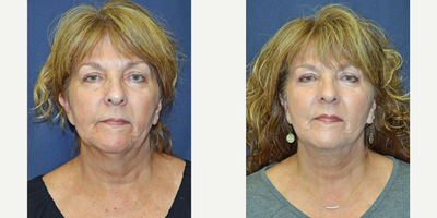 Woman treated with FaceTite - Woman treated with FaceTite