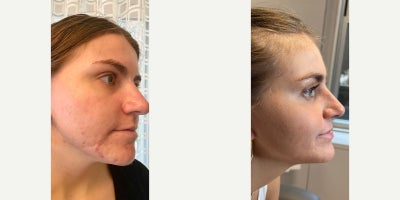 POWERFUL PROVEN RESULTS | HORMONAL ACNE SCAR TRANSFORMATION - When this beautiful patient first walked into my office, she was carrying years of emotional weightscars not just on her skin, but on her self-esteem. A severe hormonal acne outbreak had left deep marks behind, and she genuinely believed she'd have to live with them forever.She told me, Dr. Emer, Ive tried everything. Skincare, peels, other doctors. Nothing worked.But thats where I come in. Because I dont just treat skinI transform it.Before we even touched a laser, we focused on calming her active acne with a tailored skincare protocol and medical-grade peels to prep her skin. Once her inflammation was under control, we launched a customized acne scar protocol built just for her unique skin type and scar depth. No cookie-cutter treatments here.Over two intense sessions, I combined:
