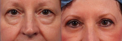 Upper and lower eyelid lift (blepharoplasty) with fat grafting and laser resurfacing - She underwent upper eyelid and lower eyelid lift (transconjunctival) surgery to rejuvenate her eyes. Fat grafting was performed along with laser skin resurfacing to reverse deflation and sun damage at the same time.