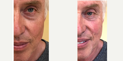 55-64 year old man treated with Dermal Fillers, Restylane Silk, Cheek Augmentation - 60s active male patient who desired a non surgical rejuvenation of the face. He underwent filler injections under the eyes to the tear trough hollows and mid face cheek regions.Shown before and immediately after treatment.