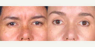 45-54 year old female treated with Brow Lift - Brow lift & Blepharoplasty