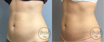 35-44 year old woman treated with UltraShape Power - Ultrashape Power