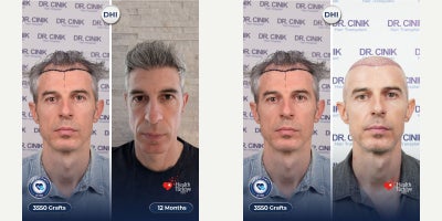 45-54 year old man treated with Hair Transplant, DHI Hair Transplant - 3550 grafts, 12 months DHI hair transplant