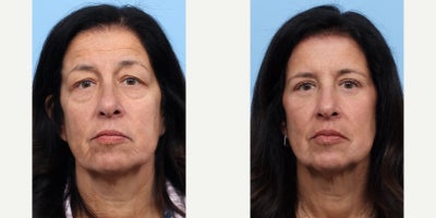 55-64 year old woman treated with Eyelid Surgery, Double Eyelid Surgery - Dr. Wise performed both an upper and lower blepharoplasty on this patient to reverse the signs of aging and remove her undereye bags.