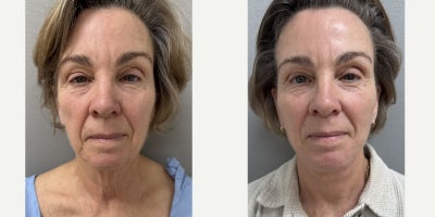 65-74 year old woman treated with Facelift - 67 y/o underwent NaturalLift our office O.R. under sedation.