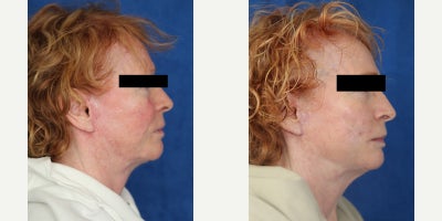 Surgical Removal of Facial Silicone Injection Improves Lips, Cheeks, and Comfort - Silicone injection removal of the face can restore a softer, healthier appearance when old foreign material begins causing swelling, discoloration, and discomfort. Our patient is a 64-year-old White female who had silicone injections placed in her cheeks and upper and lower lips 19 years ago. Over time, she developed facial swelling, changes in skin color, and pain related to the injected product, which led her to seek treatment from Dr. J. Timothy Katzen. Under general anesthesia, Dr. Katzen performed surgical silicone removal of the face, specifically treating the cheeks and both lips. This facial reconstructive procedure involves carefully opening the affected areas, identifying the silicone and surrounding scar tissue, and removing as much problematic material as safely possible while preserving natural facial structure. Silicone injections in the face can trigger chronic inflammation, firmness, irregular texture, visible distortion, and discoloration that do not improve without surgery. By removing the foreign material and refining the damaged tissue, this type of facial silicone removal surgery can improve comfort, contour, and skin appearance. Her photos were taken 3 months after surgery and already show remarkable results, including less swelling, improved color, and a more natural facial contour. She is also relieved of most of her pain, which makes her outcome especially meaningful.