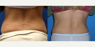 Woman treated with Tummy Tuck - Woman treated with Tummy Tuck