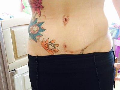 Is the swelling above the hip bone normal after flank lipo ...