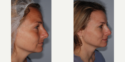 Woman treated with Lip Fillers, Lip Implants - Woman treated with Lip Fillers, Lip Implants