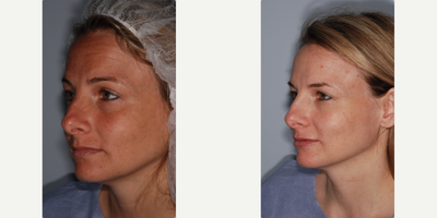 Woman treated with Lip Fillers, Lip Implants - Woman treated with Lip Fillers, Lip Implants