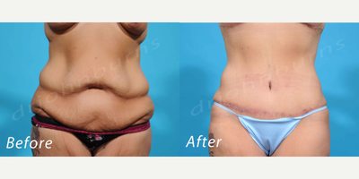 35-44 year old woman treated with Panniculectomy - body contouring after massive weight loss