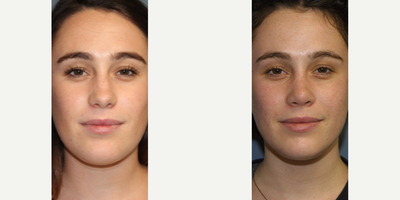Woman treated with Rhinoplasty - Woman treated with Rhinoplasty