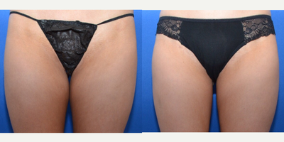 Slim Lipo - Before and 3 Months after Slim LipoSculpting of the inner thighs & knees. Patient requested a thigh gap. Justin Yovino, MD at Ideal Face & Body in Beverly Hills, California.
