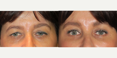 35-44 year old woman treated with Eyelid Surgery - upper and lower blepharoplasty, midface and endobrow lifts