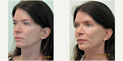 45-54 year old woman treated with Mini Facelift, Facial Fat Transfer, and Upper Eyelid Surgery - This active middle-aged woman presented to our Center with the concerns of heaviness in her upper eyelids, thinning of her midface/cheeks, and mild drooping of her jawline. She stated that she looked tired and sad all of the time due to the overall deflation of most of her face.Her initial exam revealed significantly hooded eyelids to the point where no part of her lid could be seen, deflation of her cheek pads, and mild laxity(looseness) of her lower 1/3 of her face including the jawline.We decided together that the proper plan of action to address her needs would be to perform an upper blepharoplasty, a jawline lift, and to augment her cheeks with her own fat (autologous fat transfer from fat from her abdomen).Under local anesthesia and oral sedation with xanax (no IV or General Anesthesia was needed), all three procedures were performed in one sitting in under 3 hours time.Her results demonstrate significant, and natural, opening of her eyelids, increased volume in her cheeks, and a sharpened and tighter jawline. She was able to return to full/normal activity after 10 days.