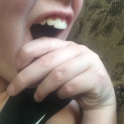How can I make my two front teeth look shorter? (photos) Doctor Answers