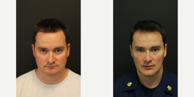 25-34 year old man treated with Chin Surgery - Genioplasty