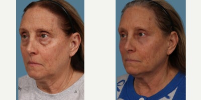 65-74 year old woman treated with Eyelid Surgery, Fraxel Repair, Facial Fat Transfer, Botox - Our patient is thrilled with her results so far just 3 months after upper & lower Blepharoplasty surgery with lower eye Fraxel Re:Pair and fat transfer from the abdomen to the under eyes and cheeks. So much so that she decided to share her transformation photos with you. We cant wait to share her results once she is fully healed.