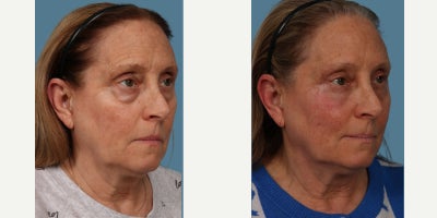 65-74 year old woman treated with Eyelid Surgery, Fraxel Repair, Facial Fat Transfer, Botox - Our patient is thrilled with her results so far just 3 months after upper & lower Blepharoplasty surgery with lower eye Fraxel Re:Pair and fat transfer from the abdomen to the under eyes and cheeks. So much so that she decided to share her transformation photos with you. We cant wait to share her results once she is fully healed.