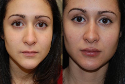 Permanent Lip Augmentation with Silikon-1000 - You can see natural looking permanent lip augmentation in my gracious patient following two treatments with Silikon-1000, an off-label filler for permanent results. Her initial treatment was in 2011, and her second was 9 days ago. We are grateful and blessed by her selfless consent to post her results.
