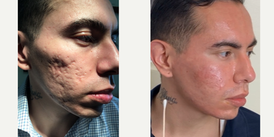 Man treated with MiXto Laser, Venus Viva - Details - Acne treated with lasers and fillers