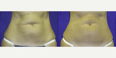 Liposonix - Liposonix
