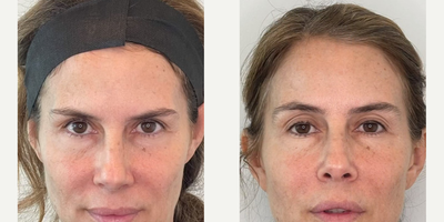 Woman treated with Morpheus8 - Woman treated with Morpheus8