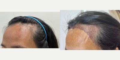 FUE hair transplant 1,700 grafts (Feminine hairline lowering) - A middle-aged Asian woman came in for a hair transplant shaven FUE technique with 1700 grafts to lower frontal hairline and create a feminine hairline.